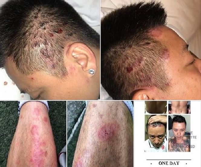 Tuấn Hưng phải sống chung với căn bệnh vảy nến Tuấn Hưng đối mặt với bệnh vảy nến trên cơ thể