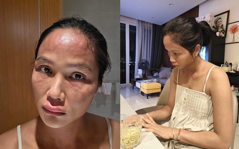 Chuyện gì xảy ra với H'Hen Niê sau khi xuất hiện với gương mặt khác lạ- Ảnh 1. H'Hen Niê với gương mặt sưng phù sau sinh