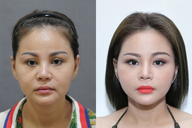 Lê Giang tiêm tai cải thiện vận mệnh